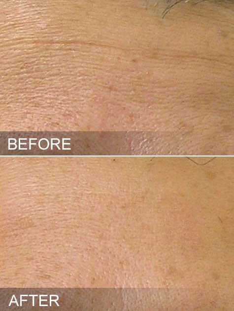 Before & After hydrafacial fine lines long island